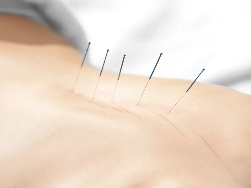 Acupuncture at Big Spirit Chiropractic in Spirit Lake