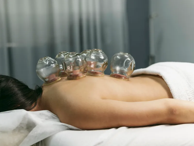 Cupping Therapy at Big Spirit Chiropractic in Spirit Lake