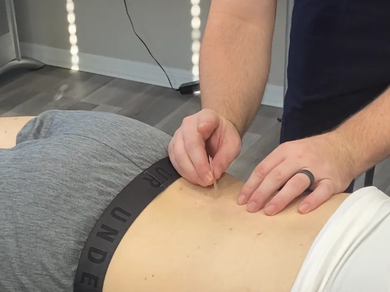 How Dry Needling works at Big Spirit Chiropractic