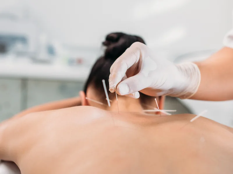 Dry Needling at Big Spirit Chiropractic in Spirit Lake
